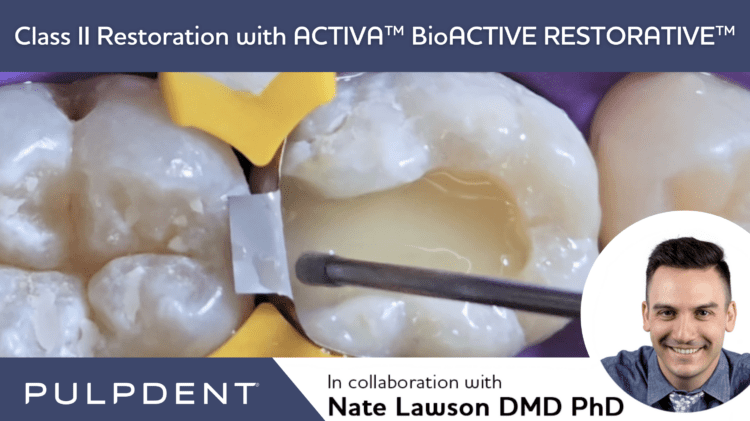 Lê mais sobre este artigo Restauração de classe II com ACTIVA™ BioACTIVE-RESTORATIVE™