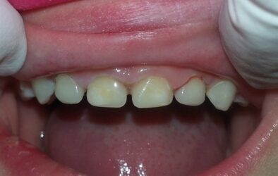 Odontologia heróica: Tira coroas para o Leigh