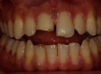 Lê mais sobre este artigo Odontologia heróica: Como Yoseph recuperou o seu sorriso