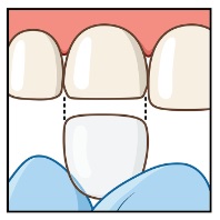 Coroa de tiras Figura 3