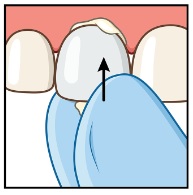 Coroa de tiras Figura 5