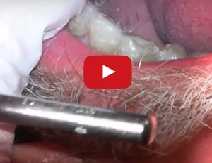 Lê mais sobre este artigo Reabilitação total da boca com ACTIVA BioACTIVE do Dr. Cory Glenn