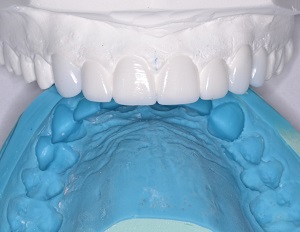 Lê mais sobre este artigo Odontologia heróica: Resgate compassivo do sorriso com ACTIVA BioACTIVE-RESTORATIVE