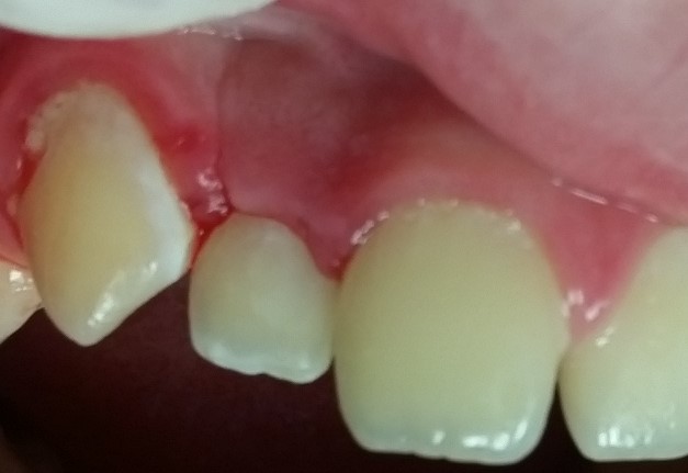 Lê mais sobre este artigo Diretamente do Operatório: Enchimento a granel com ACTIVA BioACTIVE-RESTORATIVE