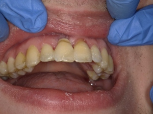 Lê mais sobre este artigo Dentisteria Heróica: Traumatismo, reabsorção externa, extração e imobilização da coroa natural com ACTIVA