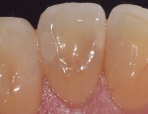 Lê mais sobre este artigo Utilização de materiais de restauração bioactivos em pacientes com elevado risco de cárie