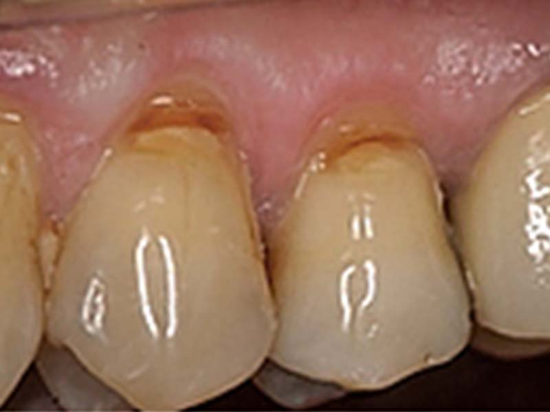clinical-procedure-embrace-class-v-1