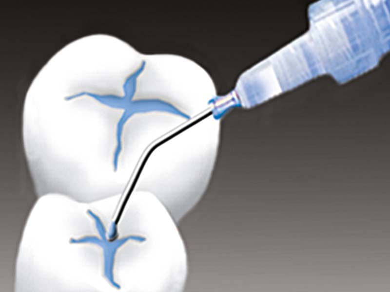 clinical-procedure-seal-rite-1