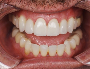 Lê mais sobre este artigo Diretamente do laboratório: Cimentação Bioactiva