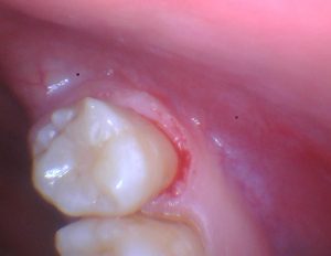 Lê mais sobre este artigo Diretamente do laboratório: Restauração bioactiva de um dente do siso cariado