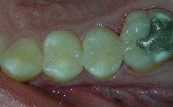 Lê mais sobre este artigo Diretamente do laboratório: Restaurações Bioactivas Minimamente Invasivas