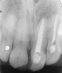 Tratamento bem sucedido de uma lesão periapical de longa duração