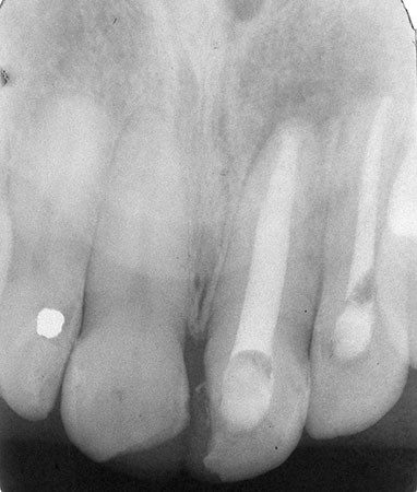 Lê mais sobre este artigo Tratamento bem sucedido de uma lesão periapical de longa duração