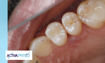NOVO VÍDEO! Dr. Joshua Austin x Dental Economics apresentam o ACTIVA Presto