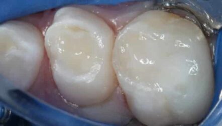 Restaurações bioactivas em odontopediatria