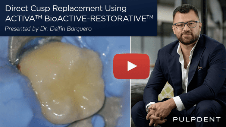 Lê mais sobre este artigo Substituição direta da cúspide utilizando uma restauração bioactiva