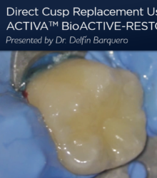 Substituição direta da cúspide utilizando uma restauração bioactiva