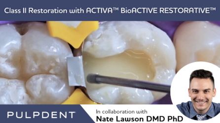 Restauração de classe II com ACTIVA™ BioACTIVE-RESTORATIVE™
