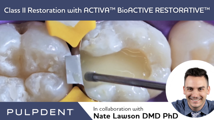 Lê mais sobre este artigo Restauração de classe II com ACTIVA™ BioACTIVE-RESTORATIVE™